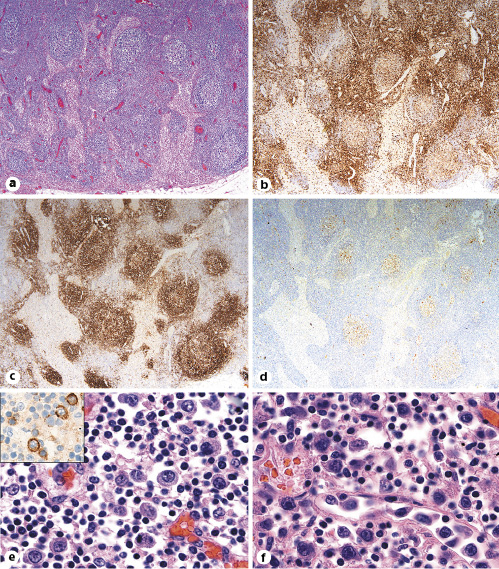 Fig. 3. Lymph nodes with preserved architecture (a; H&E, ×20), including intact follicles highlighted by CD3 (b; IHC, ×20), CD20 (c; IHC, ×20), and CD10 (d; IHC, ×20). The subcapsular and intraparenchymal sinuses contain large transformed cells with prominent nucleoli and amphophilic cytoplasm (e, f; H&E with oil immersion, ×100), which stain for CD20 (e, inset, IHC, ×60).