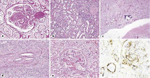 Fig. 4. Kidney showing prominent changes of diabetic nephropathy including mesangial diabetic glomerulosclerosis and extensive arteriolar hyalinosis (a; PAS, ×40), acute tubular necrosis (b; H&E, ×20), papillary necrosis (c; H&E, ×4), atheroembolic disease (d; PAS, ×20), glomerular thrombotic microangiopathy (e; H&E, ×40), and glomerular and arteriolar endothelial staining for C5b-9 (f; IHC, ×40).