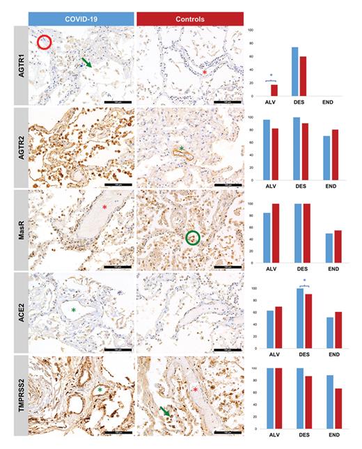 Fig. 1. Histomorphological characteristics of RAAS components and SARS-CoV-2 entry factors in lethal COVID-19 cases versus controls. Graphs display % positivity in varying cellular populations. *indicates p values &lt;0.05. Exemplary annotations: green = positive, red = negative. Arrows: DESs/macrophages; asterisks: END; circles: ALVs. Error bars denote 100 μm. ALV, alveolar pneumocyte; DES, desquamated cell; END, endothelium; RAAS, renin-angiotensin-aldosterone system; SARS-CoV-2, severe acute respiratory syndrome coronavirus-2; AGTR1, angiotensin receptor 1; AGTR2, angiotensin receptor 2; MasR, Mas-receptor; ACE2, angiotensin converting enzyme-2; TMPRSS2, transmembrane protease serine subtype 2.