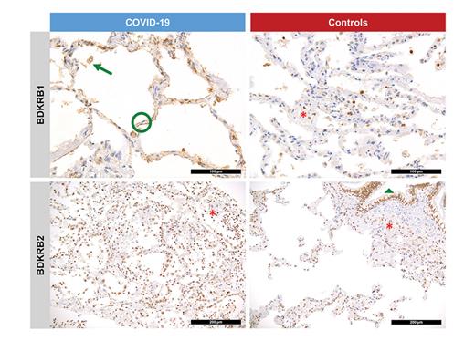 Fig. 2. Histomorphological characteristics of BDKRB1 and 2 in lethal COVID-19 cases versus controls. Annotations: green circle: membranous positivity of ALVs for BDKRB1; green arrow: membrano-cytoplasmatic positivity for BDKRB1 in a DES; red asterisk: positivity for BDKRB1 and 2 in interstitial cells including lymphocytes; green triangle: positivity for BDKRB2 in bronchial epithelium. Error bars denote 100 μm for BDKRB1 and 200 μm for BDKRB2. DES, desquamated cell; ALV, alveolar pneumocyte; BDKRB1 and 2, bradykinin receptors 1 and 2.