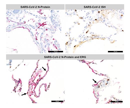Fig. 4. Detection of SARS-CoV-2 N-protein by immunohistochemistry and RNA by ISH. Top left: positivity for viral N-protein in hyaline membranes and in the endothelial compartment; top right: positivity for viral RNA in ALVs, endothelia and hyaline membranes. Scale bars denote 100 μm. Bottom: double staining with N-protein (red) and ERG (brown) reveals close association of viral proteins and the END (black arrows: endothelial cell surface coated with N-protein). SARS-CoV-2, severe acute respiratory syndrome coronavirus-2; N-protein, nucleocapsid protein; ISH, in-situ hybridization; END, endothelium; ALV, alveolar pneumocyte; ERG, ETS-related gene.