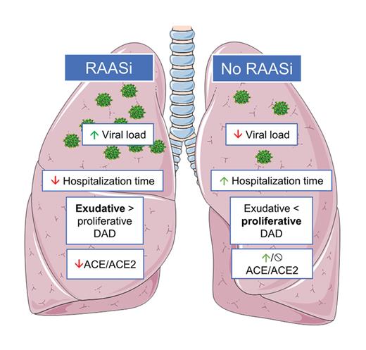Fig. 6. Summary of clinical and pathological characteristics in lethal COVID-19, dependent on RAASi-intake. Patients with RAASi-intake were observed to have higher viral loads, shorter hospitalization times (time till death) and significantly lower ACE/ACE2 ratios. A higher proportion of patients with RAASi-intake presented with exudative DAD, in line with the shorter hospitalization times. Original lung artwork by Servier Medical Art©, licensed under a Creative Commons Attribution 3.0 Unported License. COVID-19, coronavirus disease 2019; RAASi, renin-angiotensin-aldosterone system inhibitor; ACE/ACE2, angiotensin converting enzyme/angiotensin converting enzyme-2; DAD, diffuse alveolar damage.