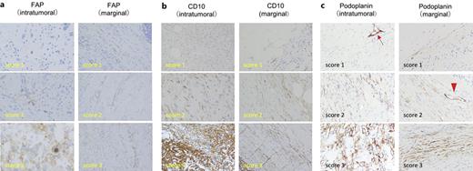 A representative image showing the intensity score for each antibody. IHC images of intratumoral/marginal FAP (a), CD10 (b), and podoplanin (c) staining intensity. The red arrow and red arrow head indicate lymphatic vessels (upper left and middle right panels [c]). FAP, fibroblast-activating protein.