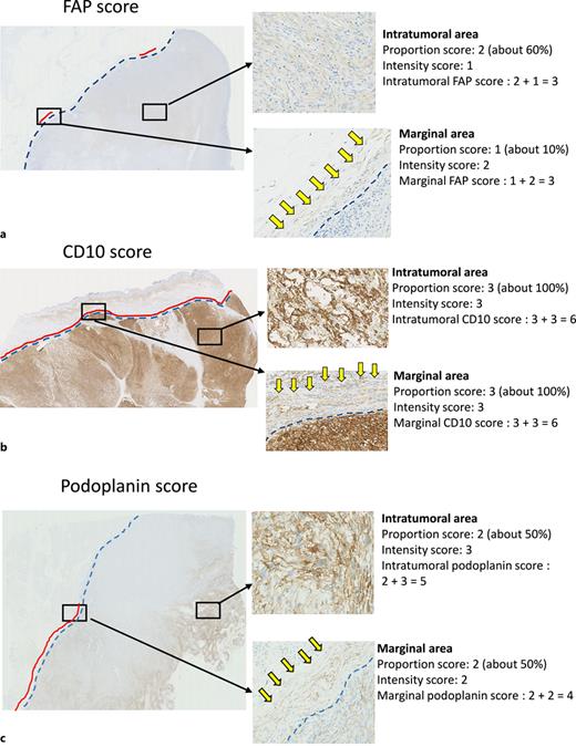 Examples of CAF score evaluation. The FAP score (a), CD10 score (b), and podoplanin score (c). Blue dotted line: tumor marginal line. Red line: marginal line in which CAFs were found. The yellow arrow indicates CAFs in the marginal area. CAF, cancer-associated fibroblast; FAP, fibroblast-activating protein.