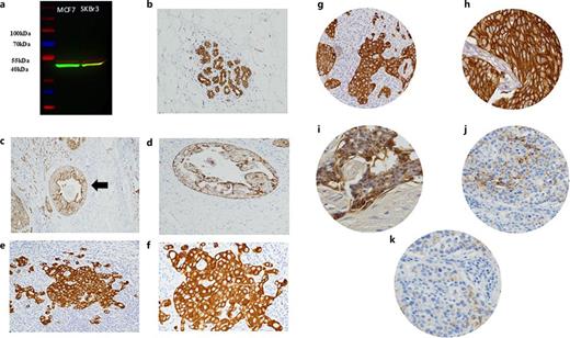Western blot and immunohistochemical expression of KRT24 in BC. Western blotting results for KRT24 expression in MCF7 and SKBR3 BC cell lines. a Red line is the housekeeping gene, while the green line is KRT24. b–f Morphological characteristics of KRT24 IHC in full-face BC tissue are shown. Normal mammary gland ductal cells show homogenous strong KRT24 staining; ×10 magnification (b). The reactivity of DCIS is heterogeneous and shows weak staining intensity; ×10 magnification (c) and ×40 magnification (d). Invasive cancer cells show homogenous strong KRT24 staining; ×10 magnification (e) and ×40 magnification (f). g–k KRT24 protein expression in BC TMA cores is shown. g and h show a strong cytoplasmic and membranous staining pattern (HC-HM) in cancer cells: ×10 magnification (g) and ×40 magnification (h). i demonstrates BC with moderate staining intensity in both the cytoplasm and membrane (MC-MM) at ×40 magnification. j and k show weak (WC-WM) to absent (AC-AM) staining intensity in both the cytoplasm and membrane: ×10 magnification (j) and ×40 magnification (k). DCIS, ductal carcinoma in situ.