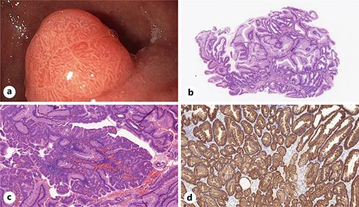 Endoscopic and microscopic features of our case. a Endoscopic morphology of duodenal foveolar adenoma. b The patient’s earlier polypectomy sample reflects foveolar adenoma with low-grade dysplasia (HE, 5×). c The second polypectomy sample contained foveolar adenoma, as well, however, with high-grade dysplasia (HE, 5×). d Foveolar differentiation was proven with MUC5AC immunohistochemistry reaction (MUC5AC, 10×). HE, haematoxylin and eosin; MUC5AC, Mucin 5AC.