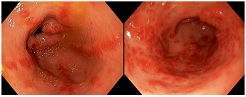 Fig. 1. Gastric antral vascular ectasia. Stripe type (left) and diffuse type (right).