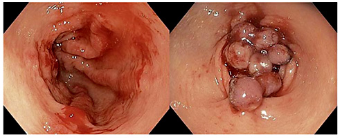 Fig. 2. Gastric antral vascular ectasia with active bleeding at the endoscopic examination (left) and after treatment with endoscopic band ligation (right).