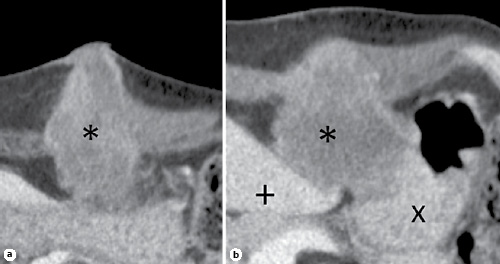 Fig. 1. First CT scan images, showing the lesion characteristics (*) and its relationships to the skin (a) and to the liver (+) and the stomach (×) (b).