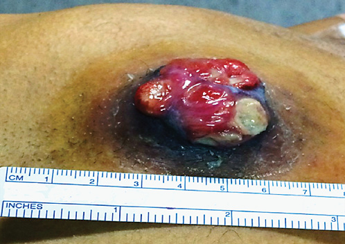 Fig. 2. Gastrostomy site metastasis of oropharyngeal cancer.