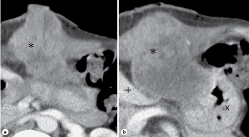 Fig. 3. Second CT scan images, showing a solid mass (*) with necrosis (a), adhering to the liver (+) and invading the stomach (×) (b).