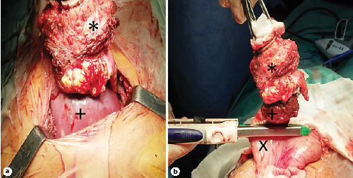 Fig. 4. Metastasis surgical resection (*). a Invasion of liver segment II (+), which was resected. b Invasion of stomach anterior wall (×).