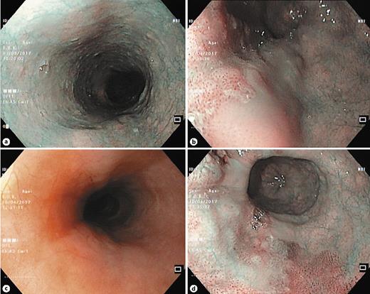 Fig. 1. Narrow-band imaging features in normal mucosa of the esophagus (a), in squamous cell dysplasia (b), and in cancer (d). c White-light features in cancer.