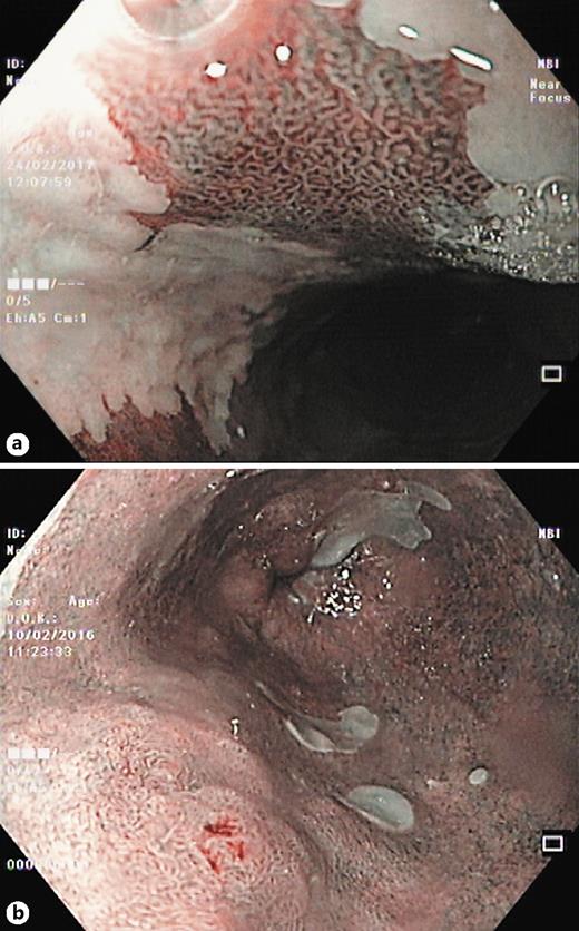 Fig. 2. Narrow-band imaging features in Barrett esophagus (BE). a Nondysplastic BE. b Dysplastic BE.