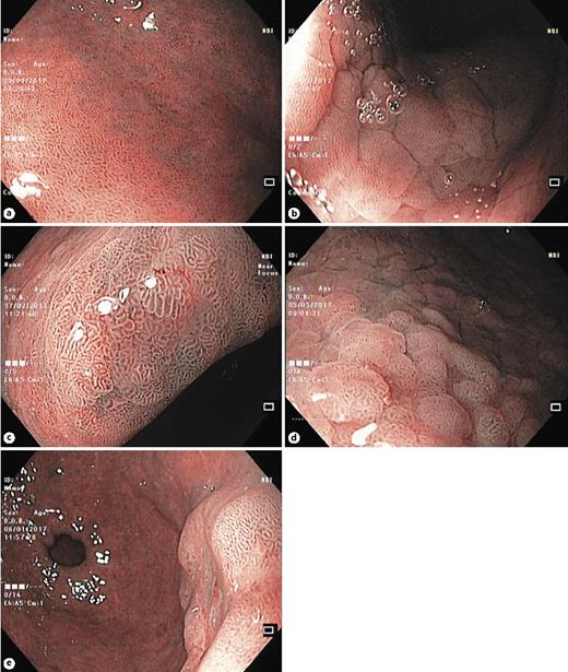 Fig. 3. Narrow-band imaging simplified classification for gastric lesions. a Pattern Aa (normal antrum, with regular oval/circular mucosa and regular vessels in the center of the gland). b Pattern Ab (normal gastric body, with regular circular mucosa and the gland surrounded by regular vessels). c, d Pattern B corresponds to intestinal metaplasia of the antrum and of the gastric body (regular, ridge, or tubulovillous mucosal patterns with regular vessels; presence of a light-blue crest). e Pattern C is associated with dysplasia/cancer (absent or irregular mucosal patterns with architectural distortion and irregular vascular patterns).