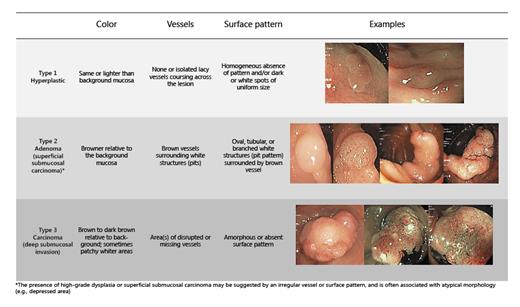 Fig. 4. NBI International Colorectal Endoscopic (NICE) classification.