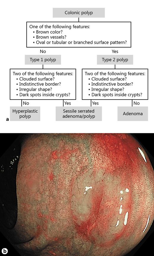 Fig. 5. a Workgroup Serrated Polyps and Polyposis (WASP) classification. b Serrated polyp.