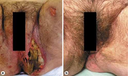 Fig. 1. a Ulcerated lesion on the inner thigh from the great lip to the perianal area, showing deep muscles and tendons. b Completely closed and healed lesion on the inside of the left thigh after 4 months of treatment.