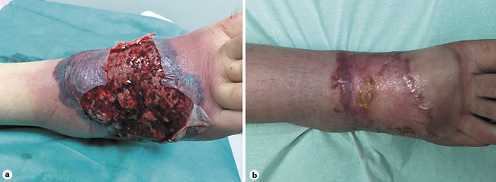 Fig. 2. a Ulcerative lesion on the right foot with peripheral erythema and undetermined borders. b Almost completely healed lesion on the right foot after 4 months of treatment.
