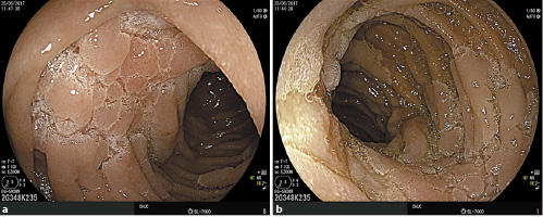 Fig. 1. a, b A duodenal polyposis carpeting the periampullary region: tubulovillous adenoma with severe dysplasia.
