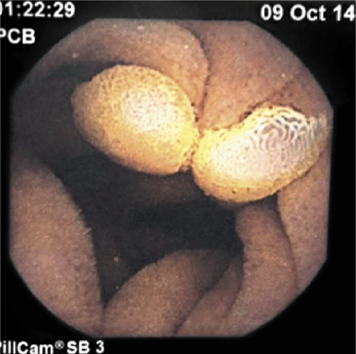 Fig. 2. Small-bowel capsule endoscopy: some small polyps.