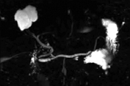 Fig. 3. MRCP with a normal biliary and pancreatic duct. Santorini not visualized; hepatic cyst in the segment VII.