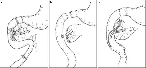 Fig. 4. a–c The main steps of the pancreas- and pylorus-preserving duodenectomy.