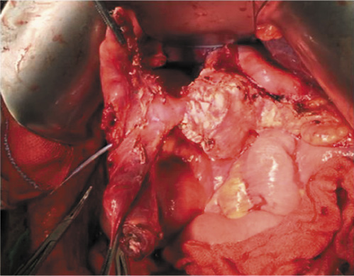 Fig. 5. The duodenum attached to the pancreas by the ampullary complex. The transcystic duct going out through a duodenotomy.