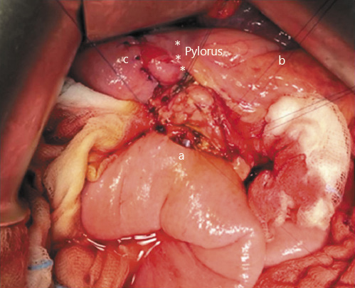 Fig. 6. a Anastomosis of the biliary and pancreatic duct to the jejunum using interrupted 5/0 Prolene sutures with an internal pancreatic stent and the transcystic catheter. b Blumgart mattress sutures. c The duodenojejunostomy and the pylorus are indicated with asterisks (*).
