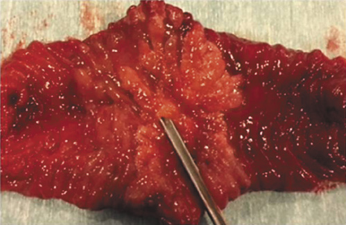 Fig. 7. The duodenum specimen showing the carpeting periampullary lesion, a tubulovillous adenoma with low-grade dysplasia.