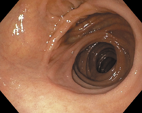 Fig. 8. A wide and regular duodenojejunostomy.