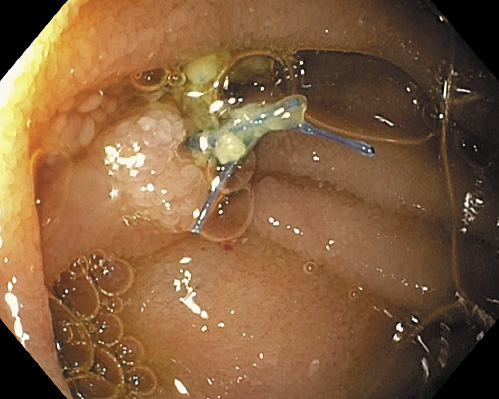 Fig. 9. The biliopancreaticojejunal anastomosis (neo-ampulla) with a residual stitch in the jejunal loop.