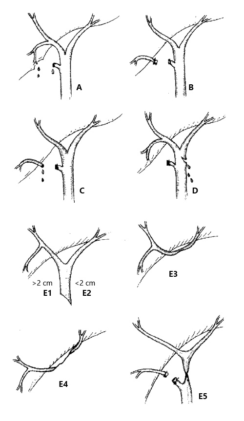 Fig. 1. Strasberg classification of biliary injuries. Type A: bile leak from a cystic duct stump or Luschka’s duct leaks. Type B: occluded right posterior sectorial duct. Type C: bile leak from divided right posterior sectorial duct. Type D: bile leak from the main bile duct involving <50% of its circumference. Type E1: transected main bile duct with a stricture of >2 cm from the hilum. Type E2: stricture located <2 cm from the hilum. Type E3: stricture of the hilum with right and left ducts in communication. Type E4: stricture separating the right and left ducts. Type E5: stricture of the main bile duct plus a stricture of the right posterior sectorial duct.
