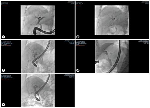 Fig. 2. Fluoroscopic images of endoscopic management of a refractory biliary leak using a fully covered self-expandable metallic stent (FCSEMS). a A high-grade (HG) biliary leak from cystic stump. b After endoscopic placement of a single plastic stent. c Persistence of a HG biliary leak after 5 days of plastic stenting. d Immediately after endoscopic placement of a FCSEMS with immediate reduction in the contrast flow through the leak. e Follow-up cholangiography immediately after FCSEMS removal at week 4. No contrast media extravasation is seen.