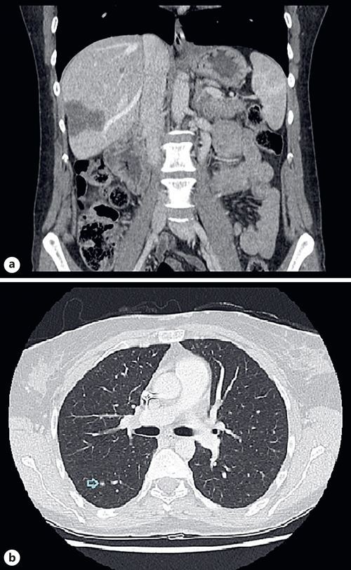 a Several subcapsular hepatic lesions with hypovascular behavior, the largest with 43 mm and 23 mm. b Several micronodular lesions dispersed throughout both lungs’ parenchyma, the largest with 3 mm.