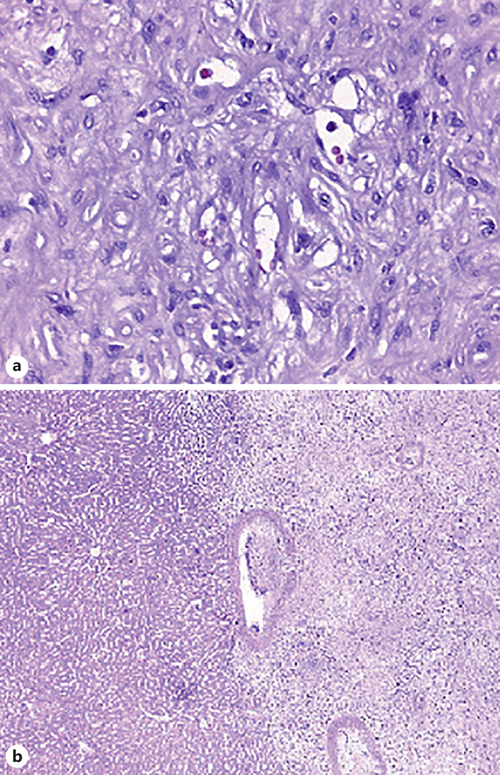 a Proliferative lesion with infiltrative growth, consisting of predominantly epithelioid, monomorphic cells, with abundant cytoplasm with formation of vascular lumens. b Neoplasm of infiltrative borders constituted by fibromyxoid stroma whit spindle and epithelioid cells with moderate atypia.
