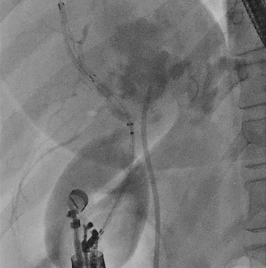 Combined EUS-BD and endoscopic retrograde cholangiopancreatography in a malignant hilar biliary obstruction, restenting the left hepatic duct and hepaticoduodenostomy on the right hepatic duct, achieving bilateral drainage. EUS: after guidewire introduction, a hybrid metallic stent was placed between the right hepatic duct and the duodenal bulb.