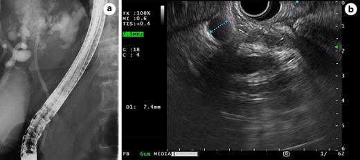 a Cholangiography after plastic stent replacement in the left hepatic duct. b Dilated right hepatic duct.