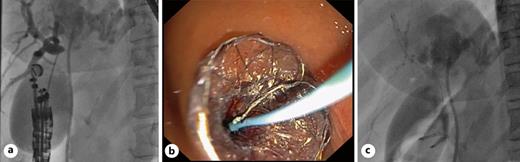 a Right hepatic duct puncture confirmation by cholangiography. b Hybrid metallic stent placement between the right hepatic duct and the duodenal bulb. c Cholangiography after bilateral biliary drainage with hepaticoduodenostomy in the right hepatic duct and plastic stent on the left hepatic duct.