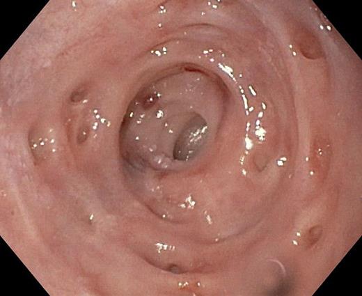 Distal esophagus with pseudodiverticulosis and a regular esophageal stricture.