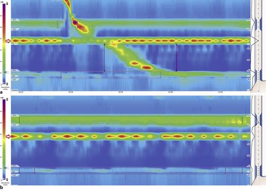 a, b High-resolution esophageal manometry: a horizontal high-pressure area is pictured just beneath the upper esophageal sphincter.