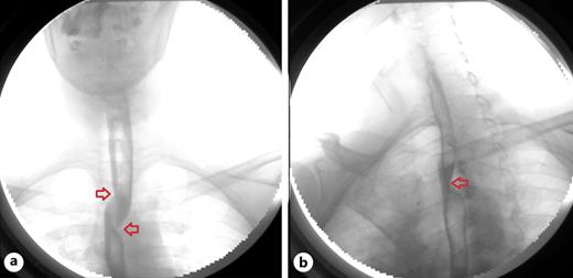 a, b Barium swallow: an extrinsic compression can be seen, as pointed out by the red arrows, between the upper and middle thirds of the esophagus.