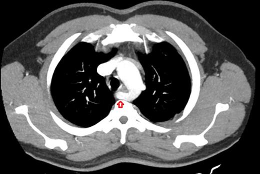 Due to suspected dysphagia lusoria, the patient underwent thoracic computed tomography angiography confirming an abnormal origin to the right subclavian artery (see arrow).