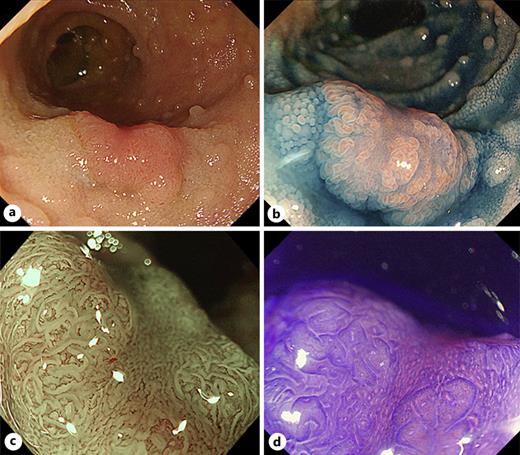 Endoscopic images showing a 10 mm slightly depressed lesion with marginal elevation in the terminal ileum, suggesting type 0-Ⅱa in the Paris classification: in white light (a); chromoendoscopy using indigo carmine (b). c Magnifying narrow-bind imaging: a tubular surface pattern with regular vessels on the marginal elevation area and regular brown vessels on the slightly depressed area, suggesting the Narrow-Band Imaging International Colorectal Endoscopic (NICE) classification type 2. d Magnifying chromoendoscopy image using crystal violet staining showing a pit pattern like type Ⅳ on the marginal area and type ⅢL on the slightly depressed area.