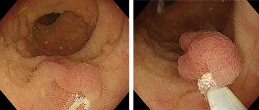 After immersing the terminal ileum with normal saline andfloating the lesion in it, we performed UEMR.