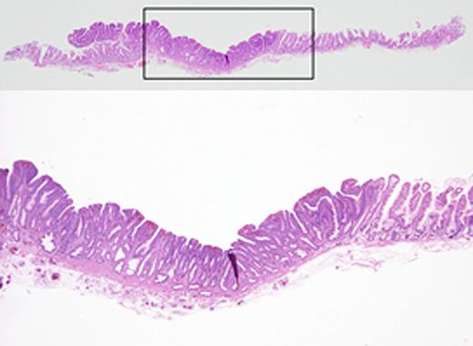 Histological examination (hematoxylin and eosin stain): A villous structure at the margins of the lesions and a tubular structure with a relatively flat surface at the center. The lesion size was 13 × 9 mm.