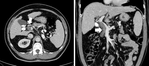 Images of a thrombus occupying more than 50% of the PV trunk.