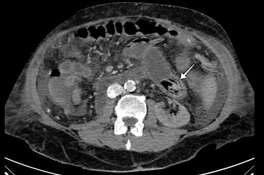 Axial abdominal CT scan image showing endoluminal content within a jejunal loop (arrow) with upstream small bowel dilation. CT, computed tomography.