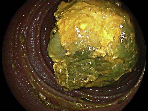 Gallstone and alimentary debris impacted in the distal jejunum.