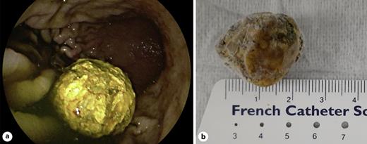 a Gallstone from the stomach before being removed with a retrieving basket. b Subsequent measurement of the gallstone confirmed its estimated size of 25 mm (photo taken after the specimen had been several hours in a refrigerator for preservation).